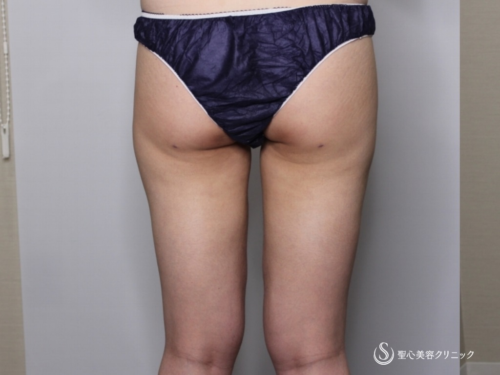 【20代女性・太腿の脂肪吸引】ベイザー脂肪吸引（術後3か月） After 