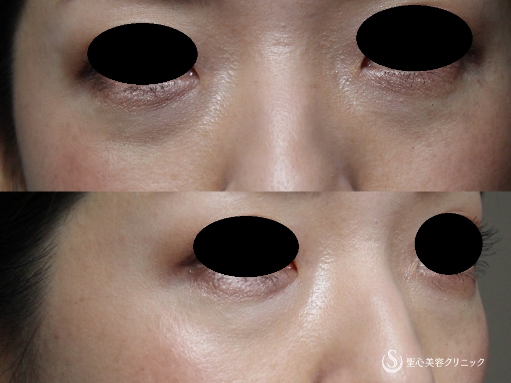 【30代女性・目の下の若返り】プレミアムPRP皮膚再生療法（術後1年） Before 