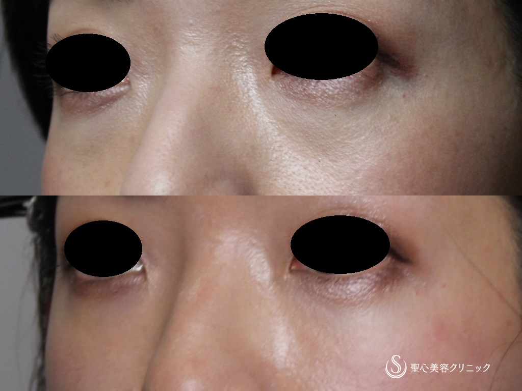 【30代女性・目の下の若返り】プレミアムPRP皮膚再生療法（術後1年） After 
