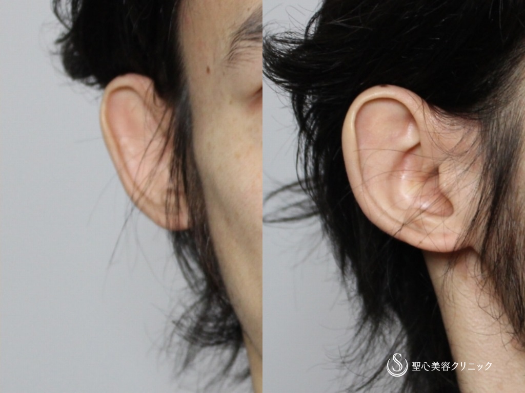 【30代男性・立ち耳の改善】立ち耳（切開法）（術後2年） Before 