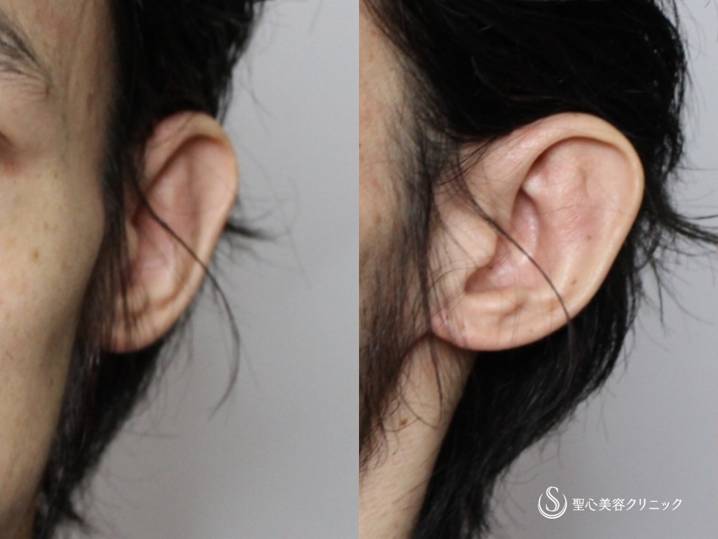 【30代男性・立ち耳の改善】立ち耳（切開法）（術後2年） Before 