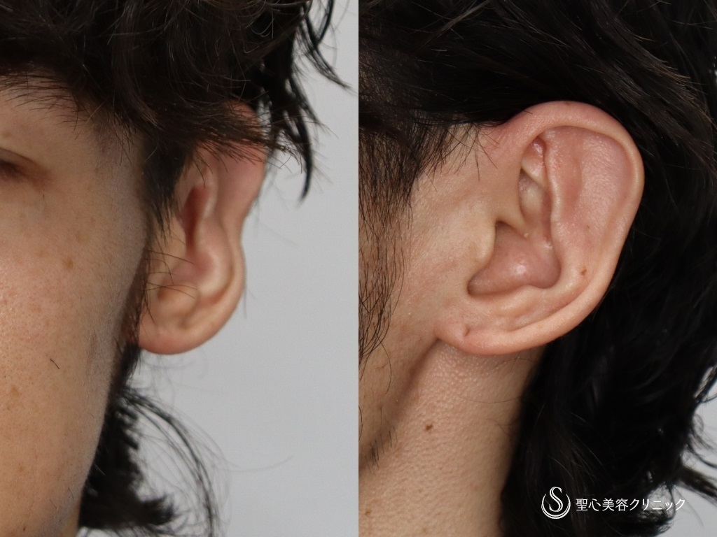 【30代男性・立ち耳の改善】立ち耳（切開法）（術後2年） After 