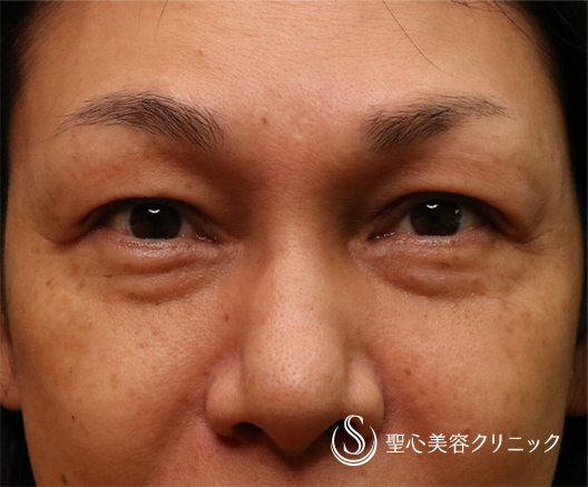 【40代女性・華やかな目もとに】眉下切開＆プレミアムPRP皮膚再生療法（目の下）（術後5ヶ月） Before 