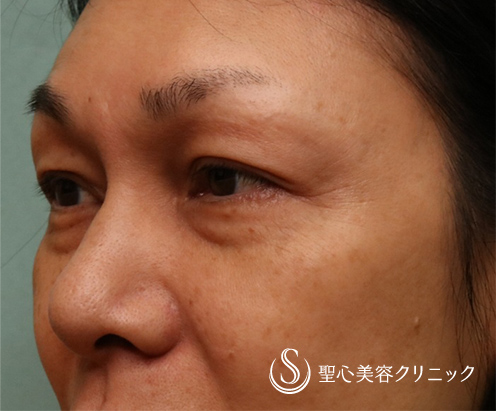 【40代女性・華やかな目もとに】眉下切開＆プレミアムPRP皮膚再生療法（目の下）（術後5ヶ月） Before 
