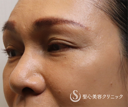 【40代女性・華やかな目もとに】眉下切開＆プレミアムPRP皮膚再生療法（目の下）（術後5ヶ月） After 