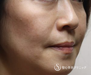 【50代女性・複数部位注入で全体の引締め効果】プレミアムPRP皮膚再生療法（8か月後） Before 