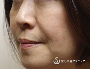 【50代女性・複数部位注入で全体の引締め効果】プレミアムPRP皮膚再生療法（8か月後） Before 
