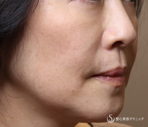 【50代女性・複数部位注入で全体の引締め効果】プレミアムPRP皮膚再生療法（8か月後） After 