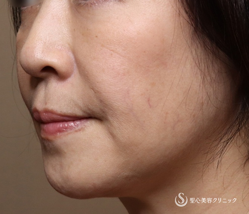 【50代女性・複数部位注入で全体の引締め効果】プレミアムPRP皮膚再生療法（8か月後） After 