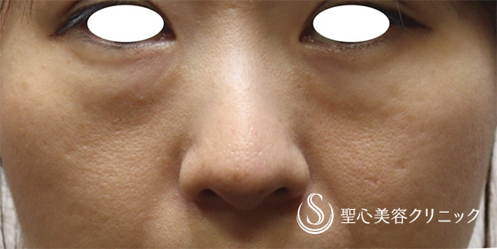 【30代女性・目の下のクマ】プレミアムPRP皮膚再生療法（術後3ヶ月） Before 