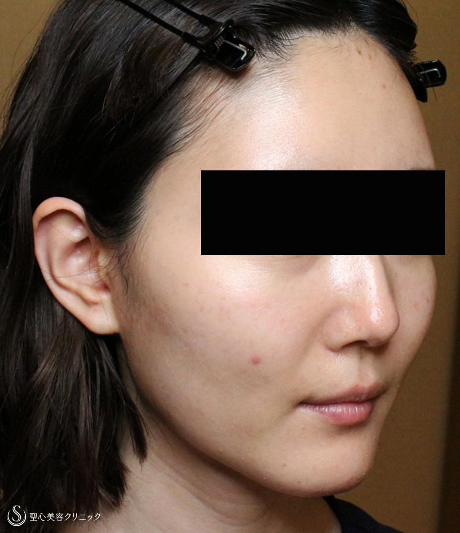 【30代女性・輪郭を整えて美人度アップ】プレミアムPRP皮膚再生療法（直後〜3ヶ月後） After 