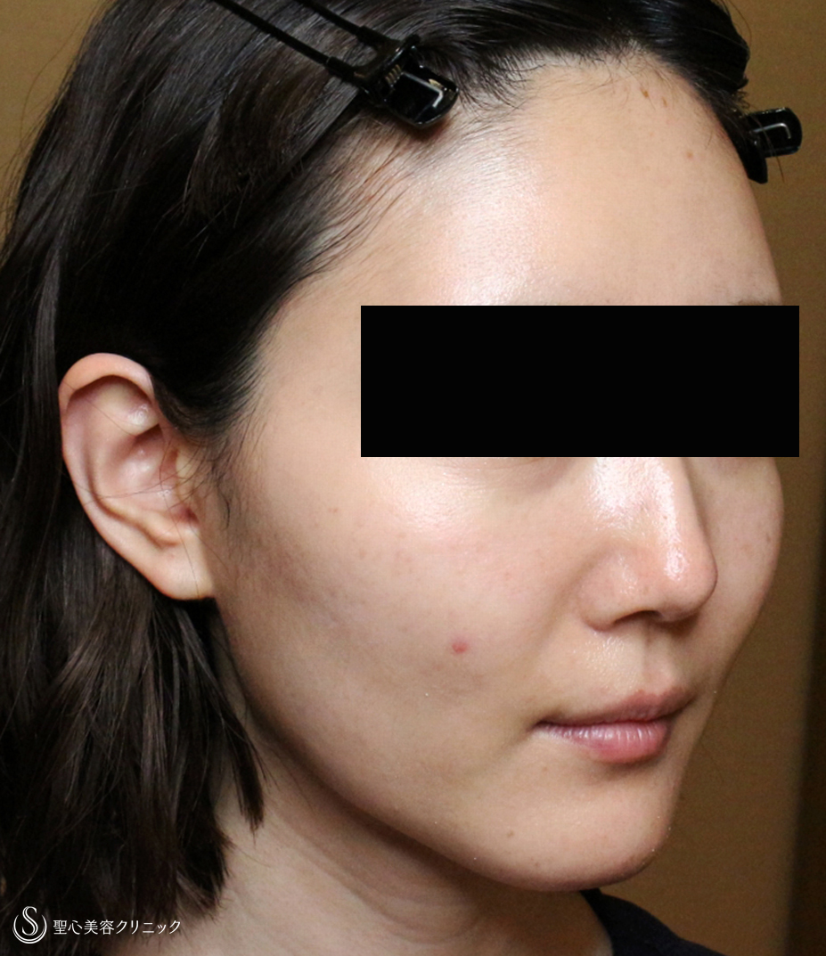 【30代女性・輪郭を整えて美人度アップ】プレミアムPRP皮膚再生療法（直後〜3ヶ月後） After 