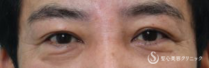 【50代男性・上眼瞼のたるみ除去】重瞼線部分開法（術後6カ月） Before 
