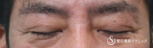 【50代男性・上眼瞼のたるみ除去】重瞼線部分開法（術後6カ月） After 