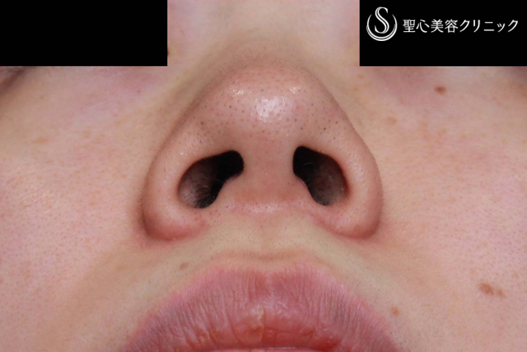 【30代女性・小鼻を小さく、左右差をなく】小鼻縮小術（術後3カ月） Before 