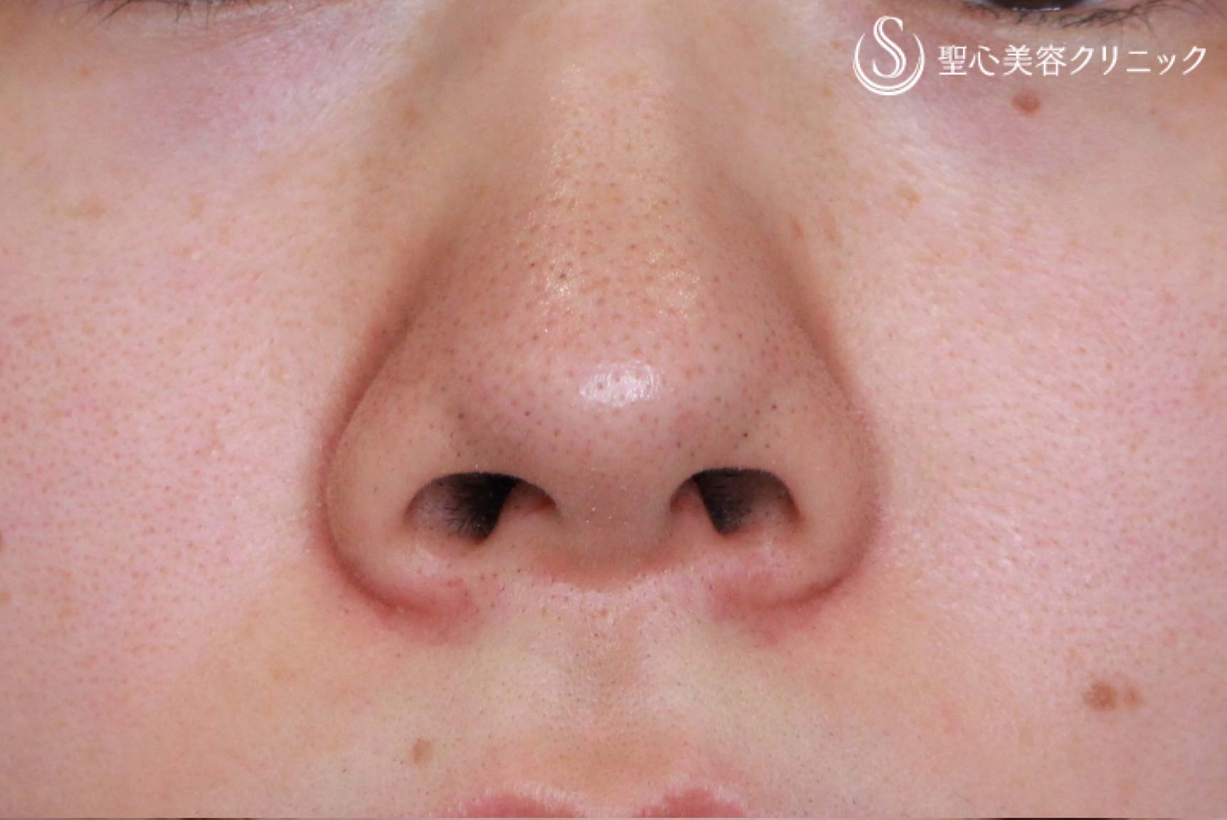 【30代女性・小鼻を小さく、左右差をなく】小鼻縮小術（術後3カ月） Before 