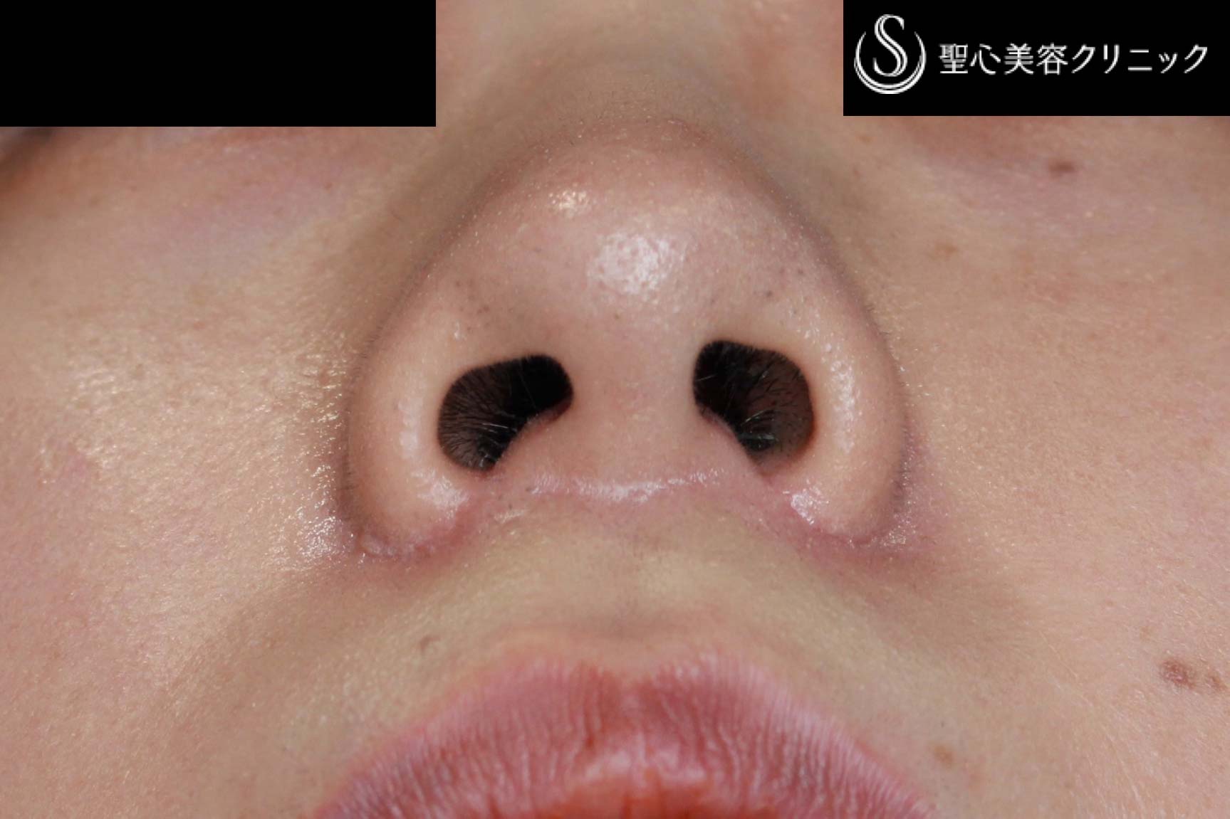 【30代女性・小鼻を小さく、左右差をなく】小鼻縮小術（術後3カ月） After 