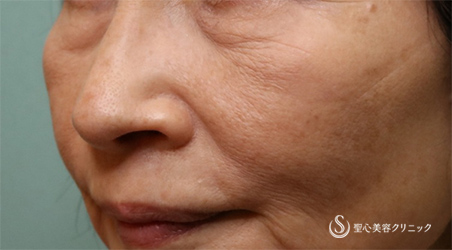 【60代女性・目の下 ほうれい線】プレミアムPRP皮膚再生療法、アンテラ3Ｄ（術後6ヵ月） Before 