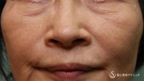 【60代女性・目の下 ほうれい線】プレミアムPRP皮膚再生療法、アンテラ3Ｄ（術後6ヵ月） Before 