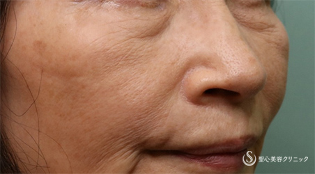 【60代女性・目の下 ほうれい線】プレミアムPRP皮膚再生療法、アンテラ3Ｄ（術後6ヵ月） Before 