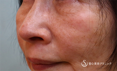 【60代女性・目の下 ほうれい線】プレミアムPRP皮膚再生療法、アンテラ3Ｄ（術後6ヵ月） After 
