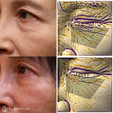 【60代女性・目の下 ほうれい線】プレミアムPRP皮膚再生療法、アンテラ3Ｄ（術後6ヵ月） After 