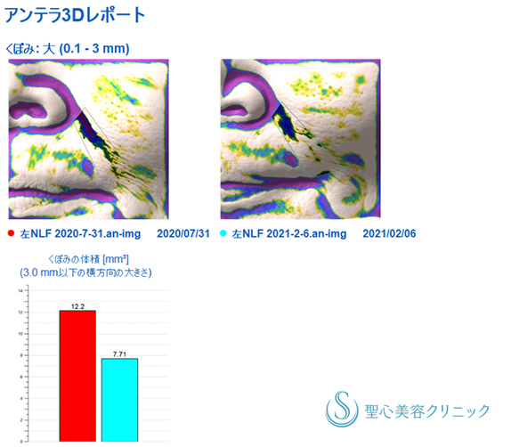 【60代女性・目の下 ほうれい線】プレミアムPRP皮膚再生療法、アンテラ3Ｄ（術後6ヵ月） Before 