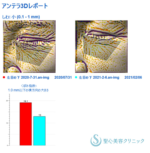 【60代女性・目の下 ほうれい線】プレミアムPRP皮膚再生療法、アンテラ3Ｄ（術後6ヵ月） Before 