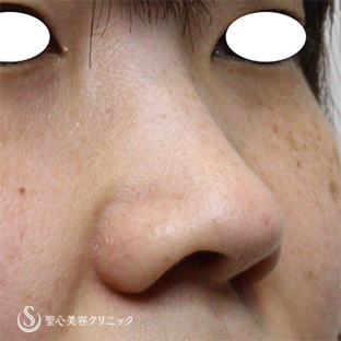 【30代女性・鼻の印象を少なくしたい】小鼻縮小（1ヵ月後）Ｇメッシュ（直後） Before 