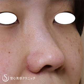 【30代女性・鼻の印象を少なくしたい】小鼻縮小（1ヵ月後）Ｇメッシュ（直後） After 
