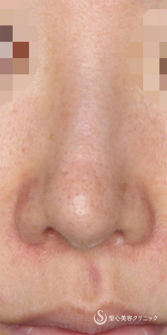【40代女性・鼻の穴を目立ちにくくナチュラルに！！】鼻孔縁下降術（術後1ヶ月） Before 
