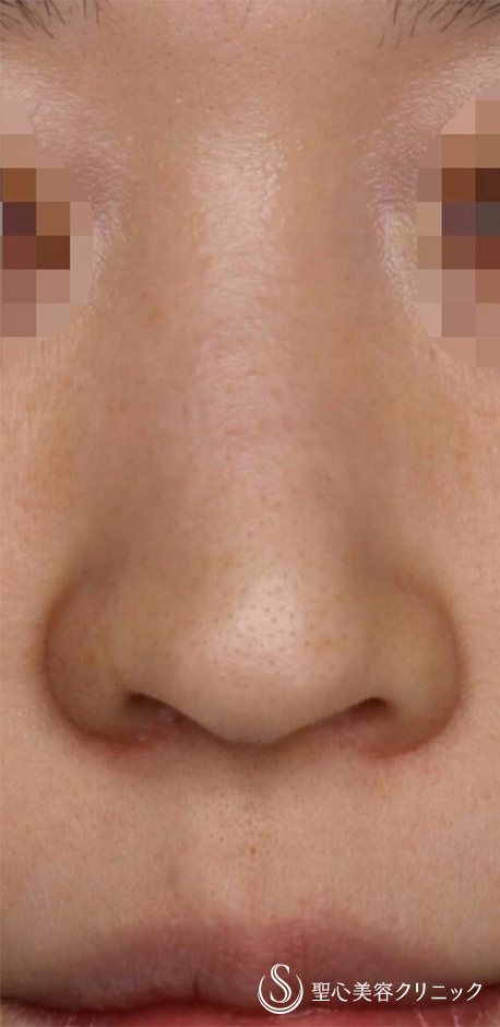 【30代女性・鼻の穴を目立ちにくく！！】鼻孔縁下降術（術後1ヶ月） Before 