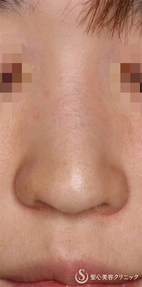【30代女性・鼻の穴を目立ちにくく！！】鼻孔縁下降術（術後1ヶ月） After 