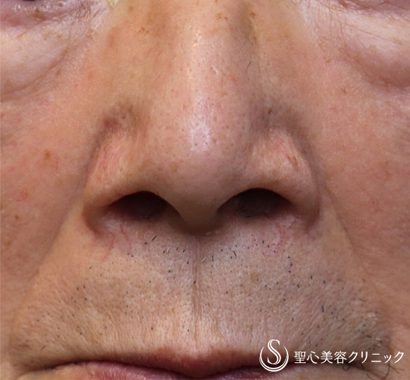 【80代男性・鼻の広がりをなくす】鼻翼縮小（内側法）（術後1ヶ月） Before 