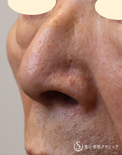 【80代男性・鼻の広がりをなくす】鼻翼縮小（内側法）（術後1ヶ月） Before 