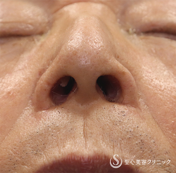 【80代男性・鼻の広がりをなくす】鼻翼縮小（内側法）（術後1ヶ月） After 