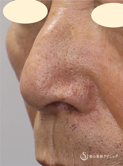【80代男性・鼻の広がりをなくす】鼻翼縮小（内側法）（術後1ヶ月） After 