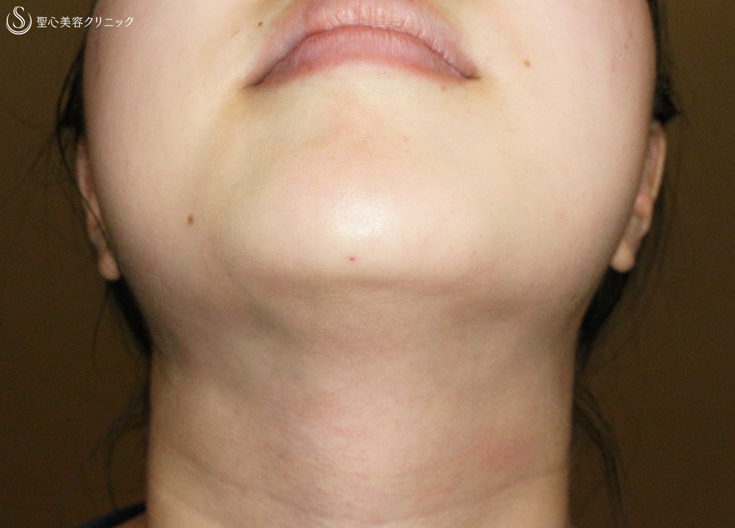 【30代女性スタッフ・顎のヒアルロン酸注入】ジュビダームビスタ® ボラックスXC（3ヶ月後） Before 