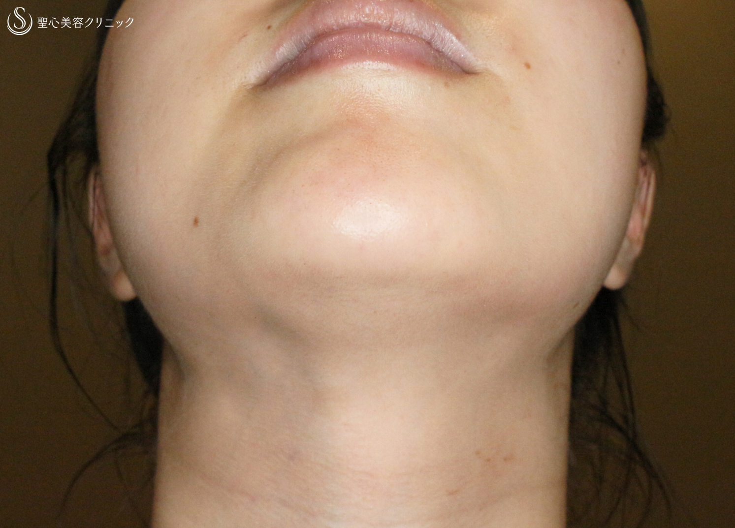 【30代女性スタッフ・顎のヒアルロン酸注入】ジュビダームビスタ® ボラックスXC（3ヶ月後） After 