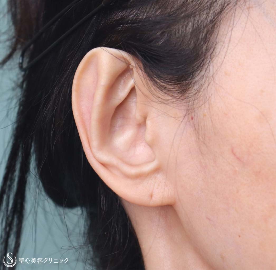 【60代女性・立ち耳を改善】立ち耳修正（埋没法）（4ヶ月後） 症例写真 美容整形、美容外科なら聖心美容クリニック