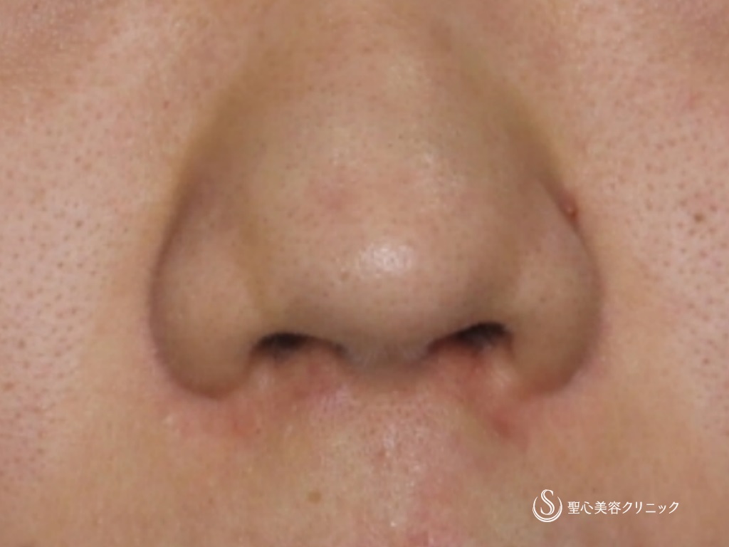 【20代女性・鼻の穴が目立つのが気になる】鼻孔縁下降術（術後1か月） Before 