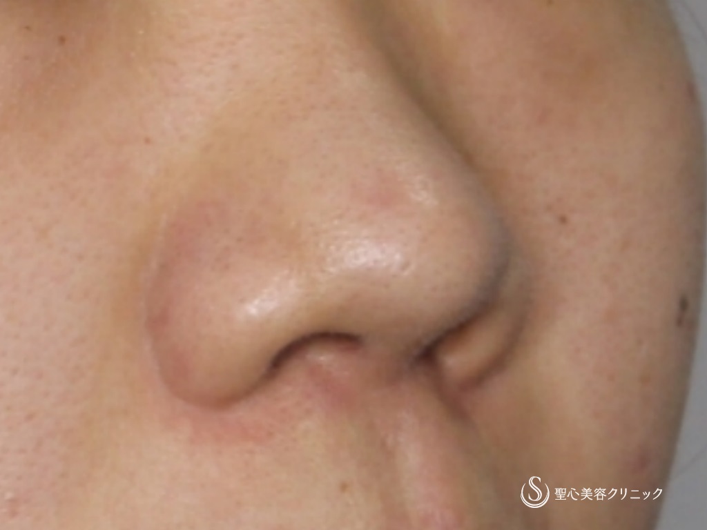 【20代女性・鼻の穴が目立つのが気になる】鼻孔縁下降術（術後1か月） Before 