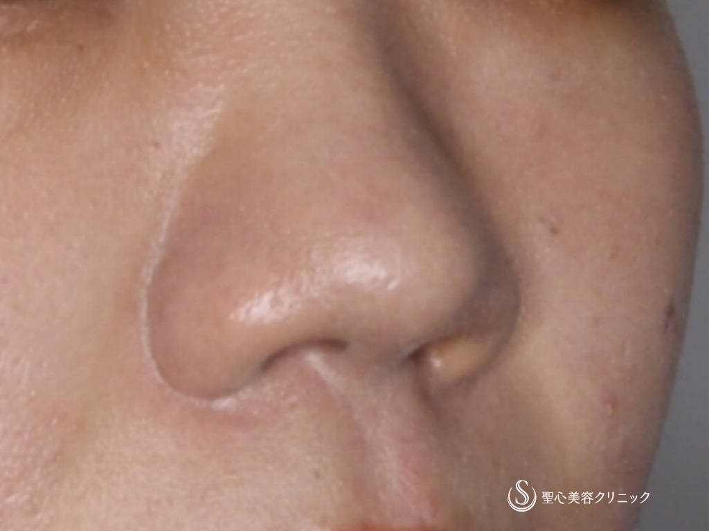 【20代女性・鼻の穴が目立つのが気になる】鼻孔縁下降術（術後1か月） After 