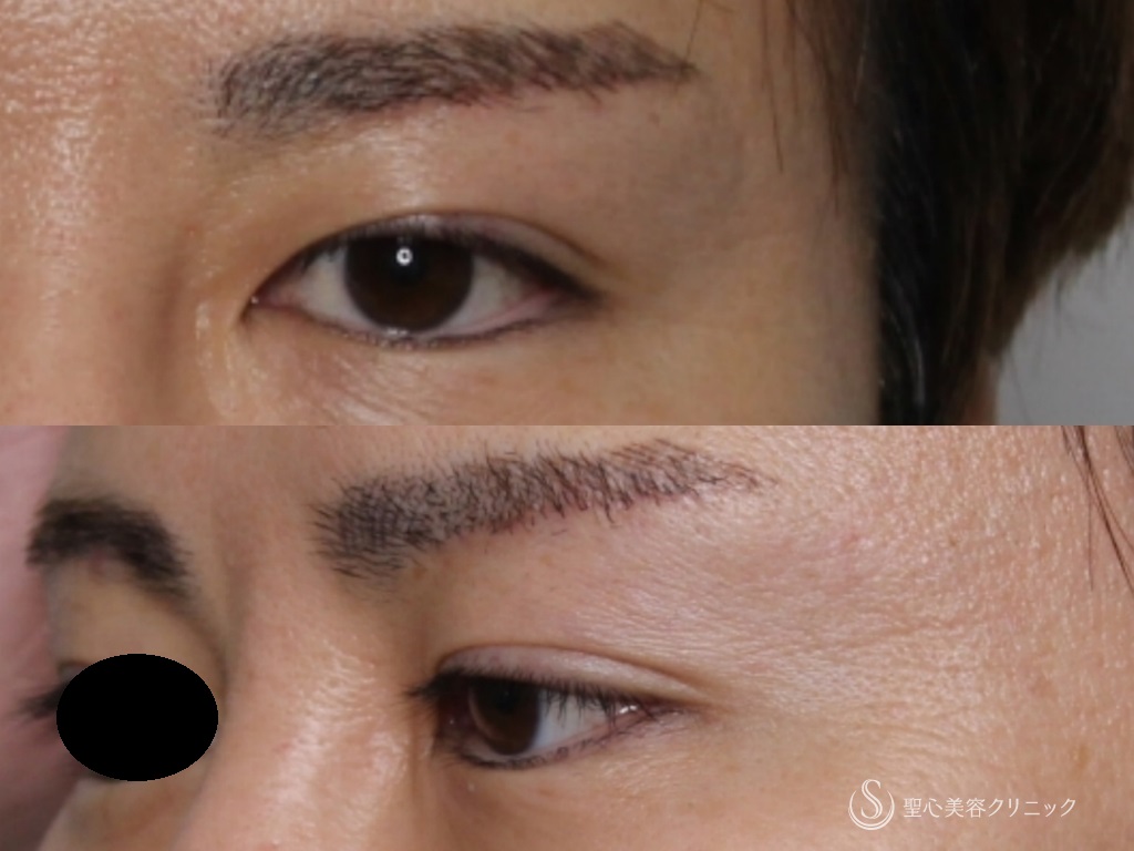 【40代男性・スッキリとした綺麗な二重ラインに】眉下切開（3か月後） 症例写真 美容整形、美容外科なら聖心美容クリニック