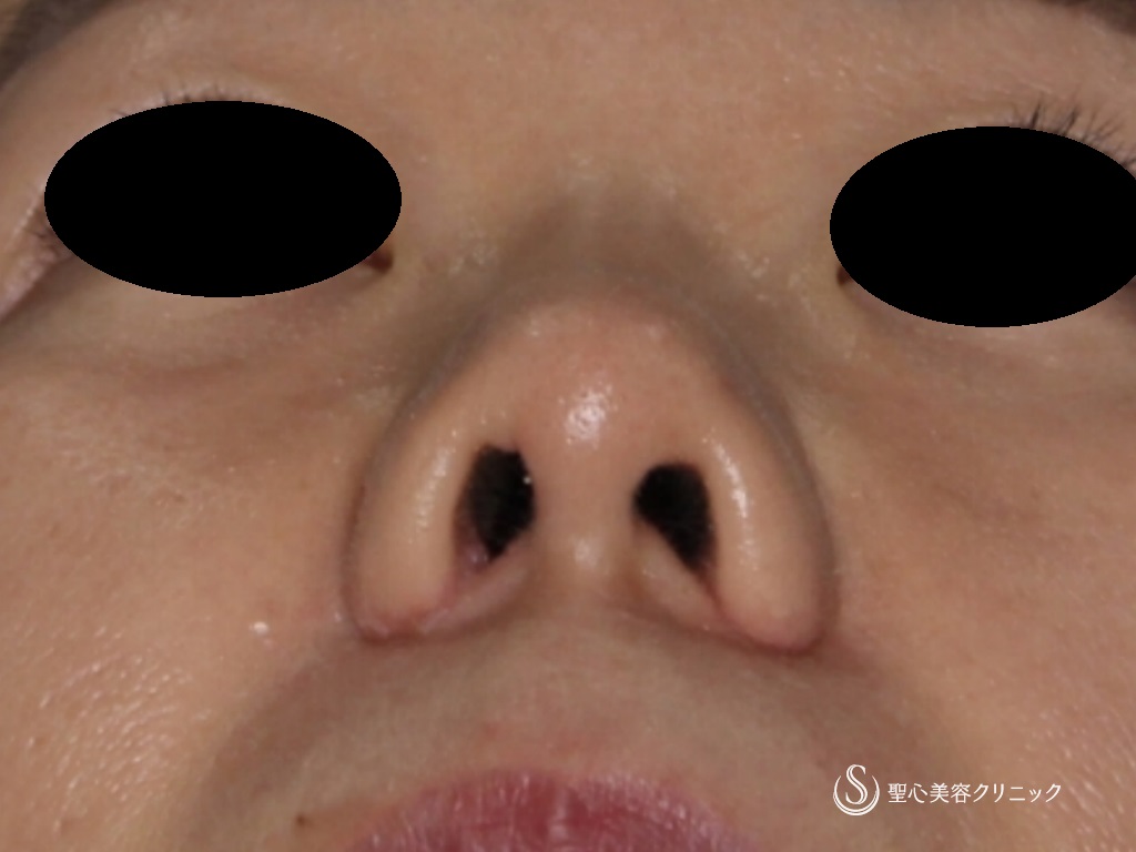 【40代女性・鼻先の形を整える】鼻尖縮小+鼻尖形成（3DPCLドーム）+小鼻縮小（術後1か月） After 
