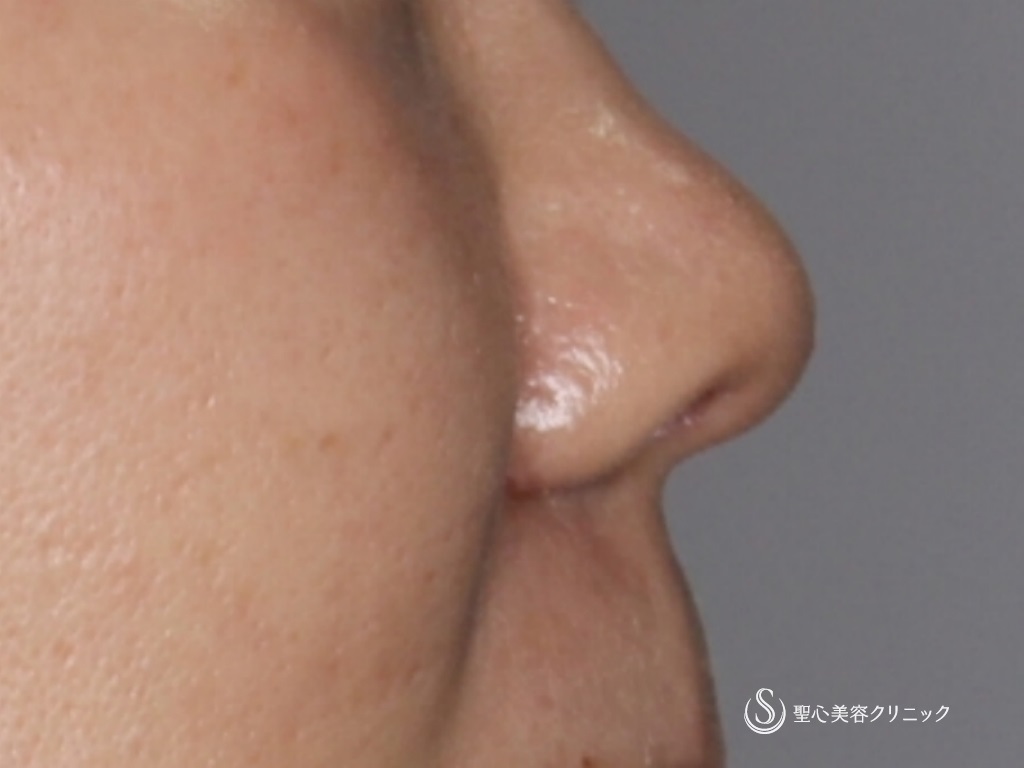【40代女性・鼻先の形を整える】鼻尖縮小+鼻尖形成（3DPCLドーム）+小鼻縮小（術後1か月） After 