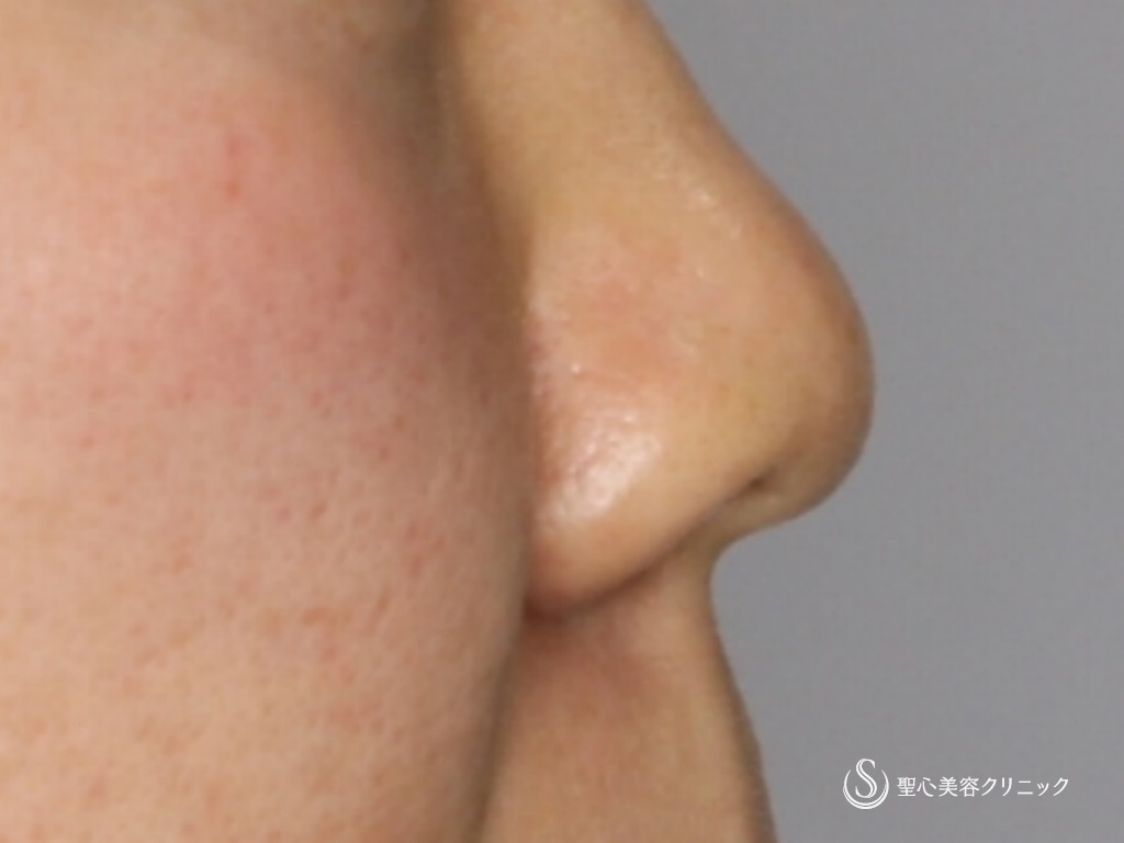 【40代女性・鼻先の形を整える】鼻尖縮小+鼻尖形成（3DPCLドーム）+小鼻縮小（術後1か月） Before 