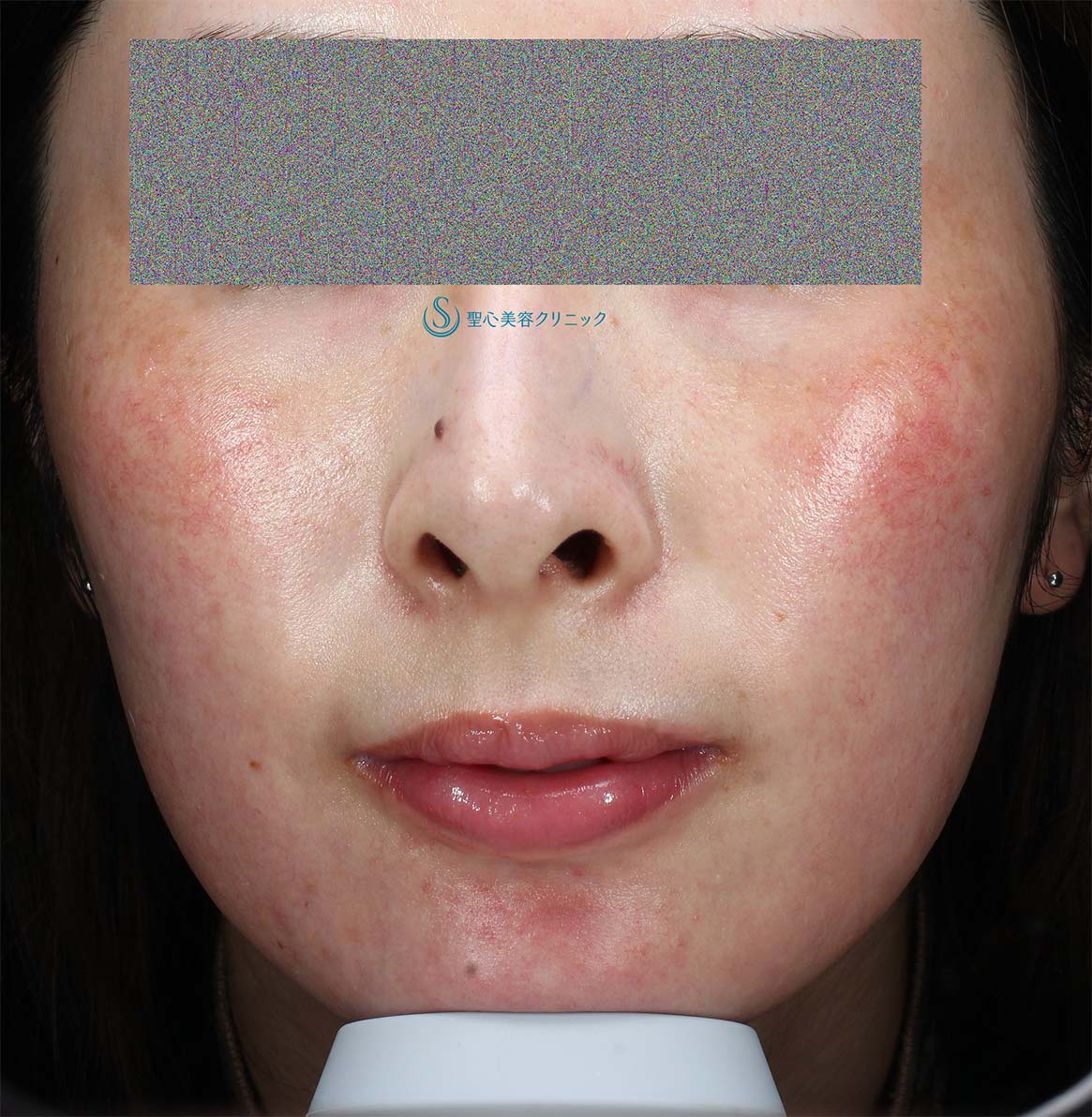 【20代女性・赤ら顔の治療】585 Quanta System Q1（3回照射後１か月） Before 