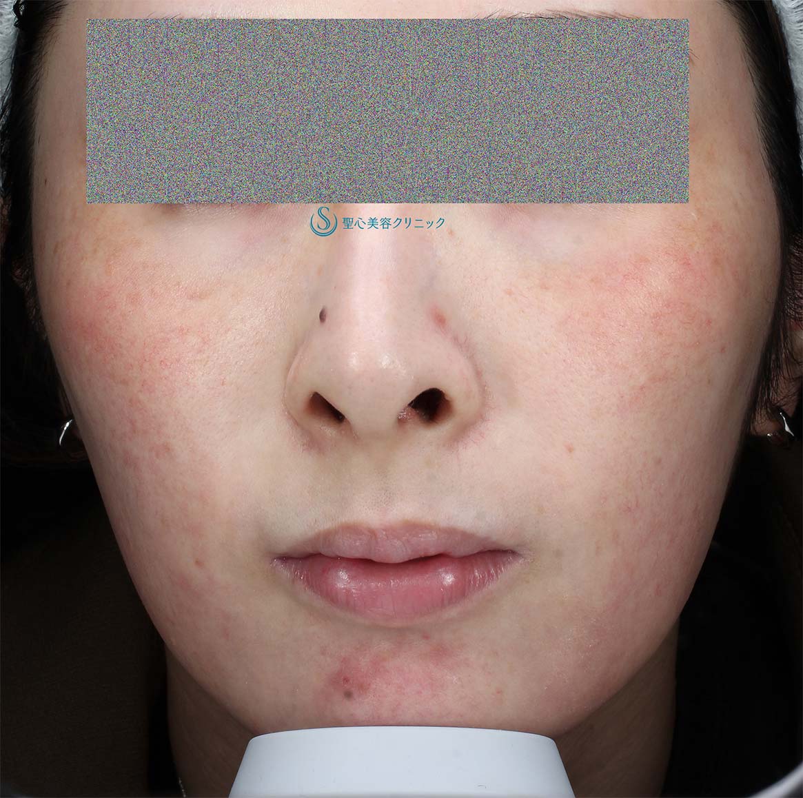 【20代女性・赤ら顔の治療】585 Quanta System Q1（3回照射後１か月） After 