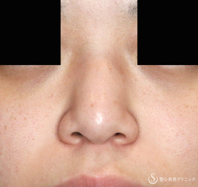 【20代女性・特徴的な鼻をスマートに】小鼻縮小術+α・鼻尖縮小＋PCLドーム ・Gメッシュ（3ヶ月後） Before 